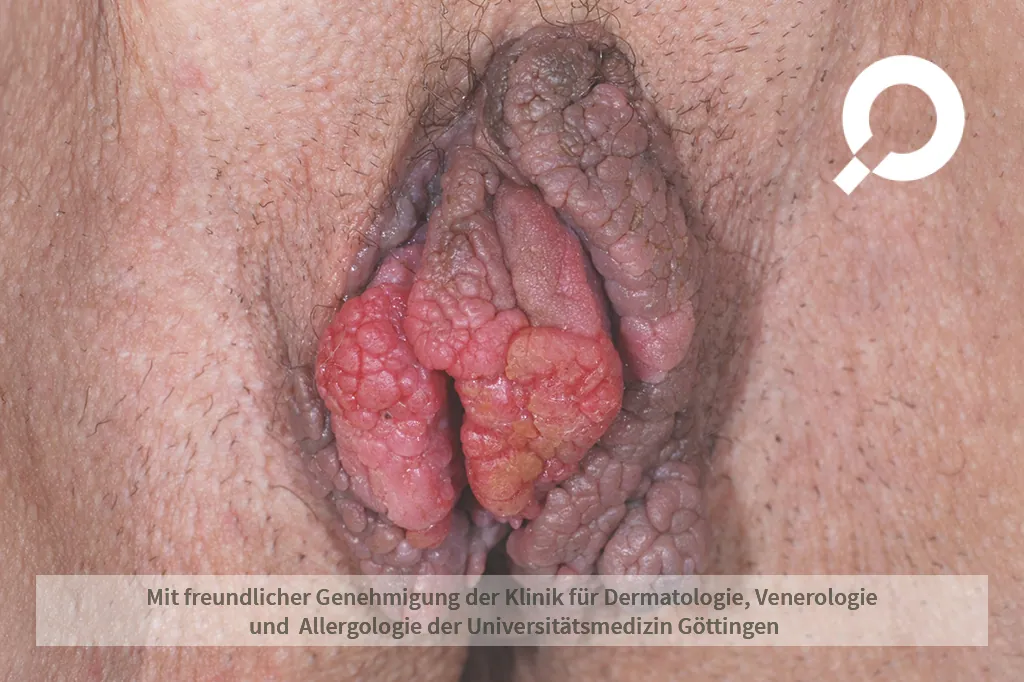 Condylomata acuminata (Kondylome, Feigwarzen)