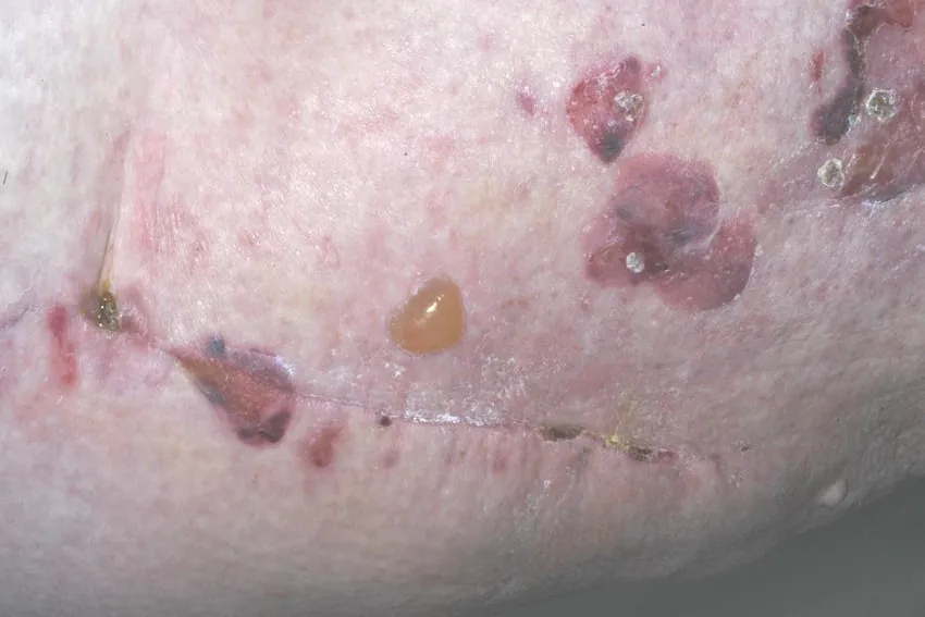 große, rote und trockene Hautflecken