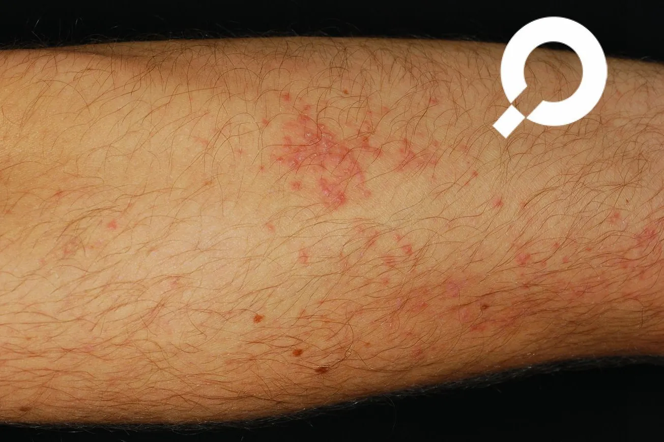 rote Pünktchen Pickeln auf dem Arm