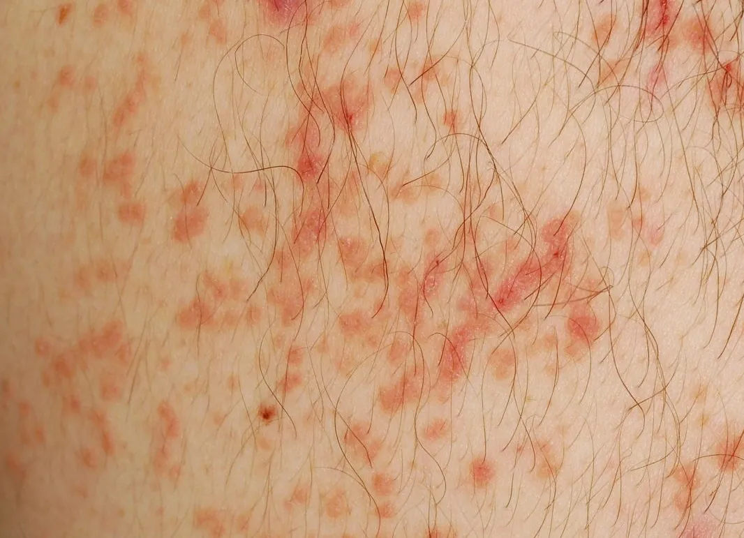 rote Pünktchen Pickeln