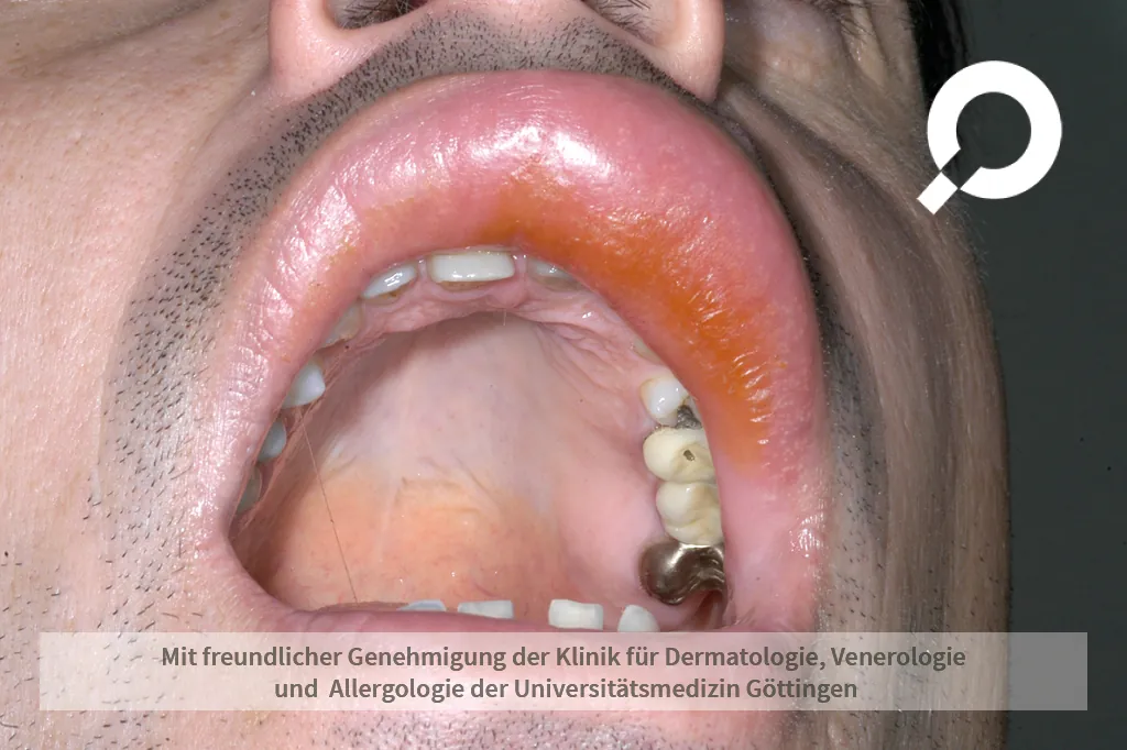 orangene Verdickung an der Oberlippe