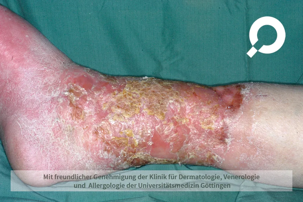 Wunde und Krusten am Knöchel