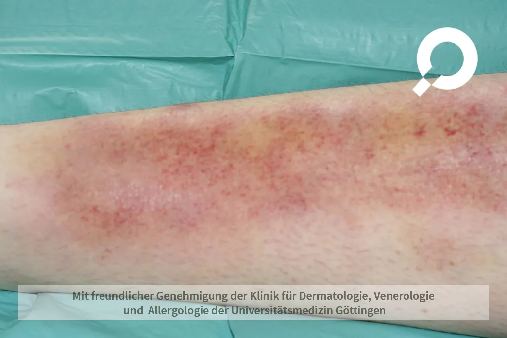 Beispielbild einer Entzündung des Unterhautfettgewebes, Erythema nodosum genannt