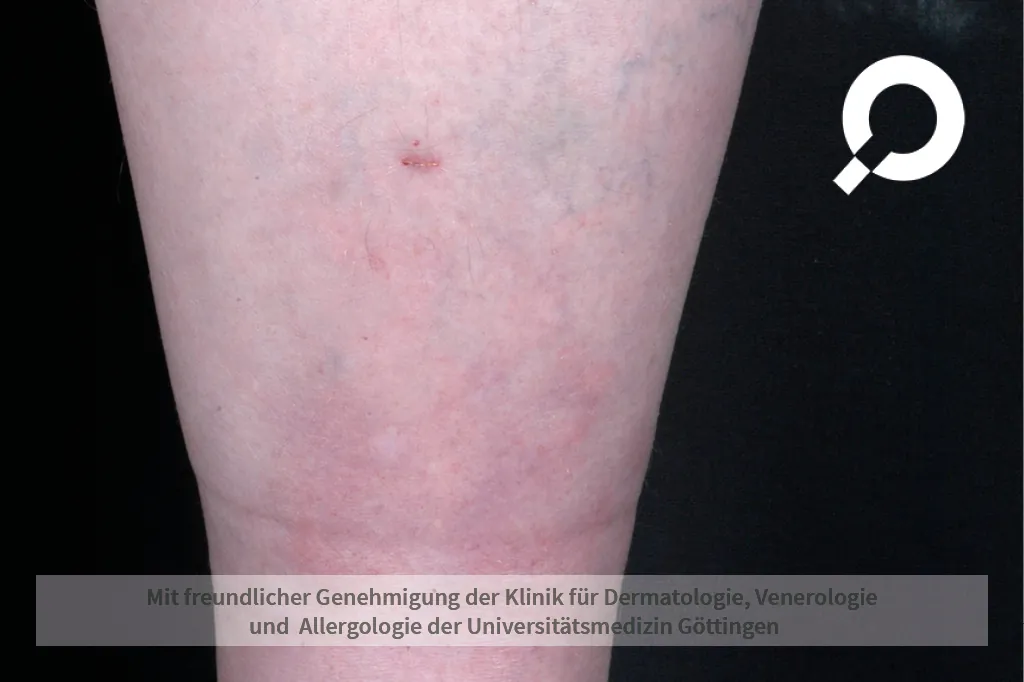 Bild eines Knotenerythems - auch Erythema Nodosum genannt