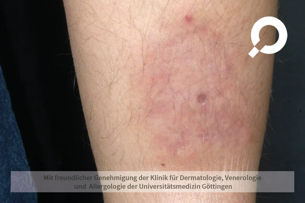 Bild der Symptome bei einer Erythema Nodosum