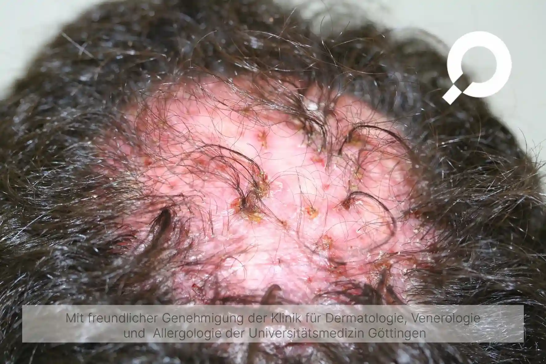 Follikulitis_Haarbalgentzündung