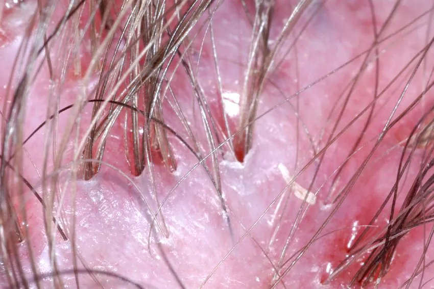Follikulitis_Haarbalgentzündung