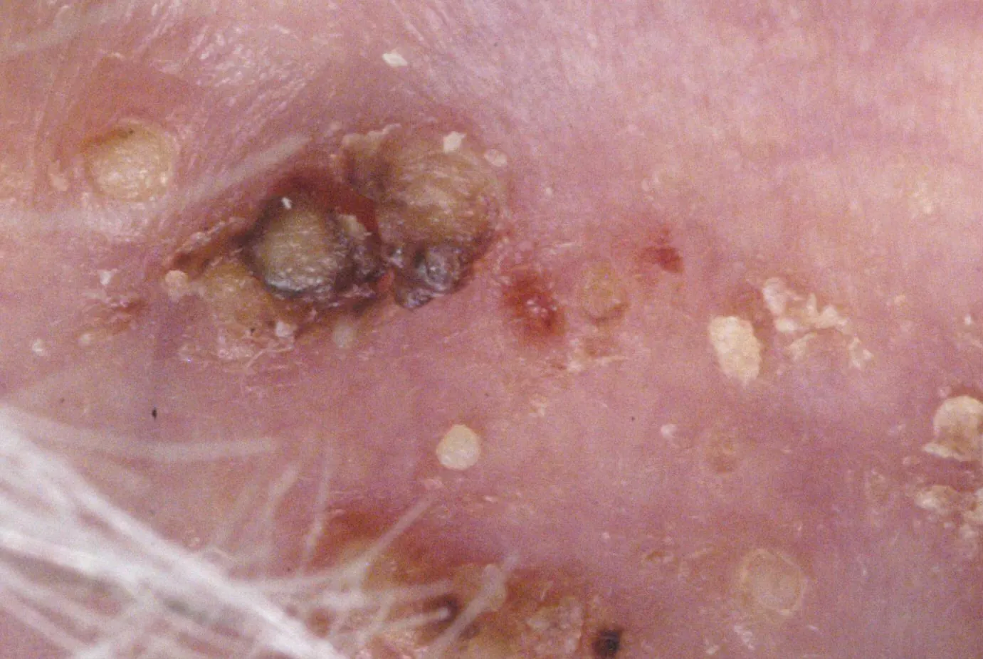 Follikulitis_Haarbalgentzündung