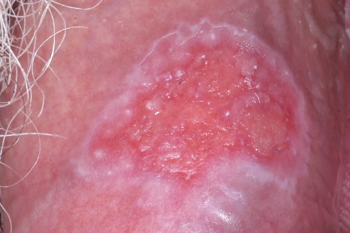 Genitalherpes