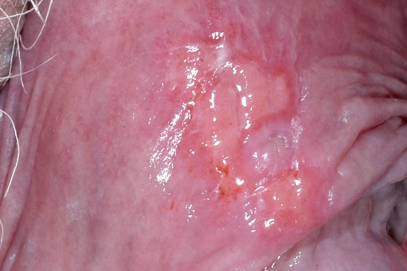 Genitalherpes