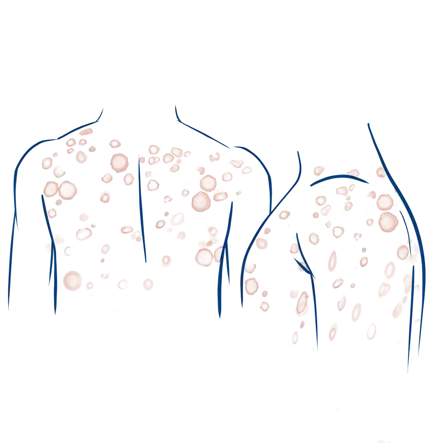 Symptome bei Granuloma Annulare Erkrankungen