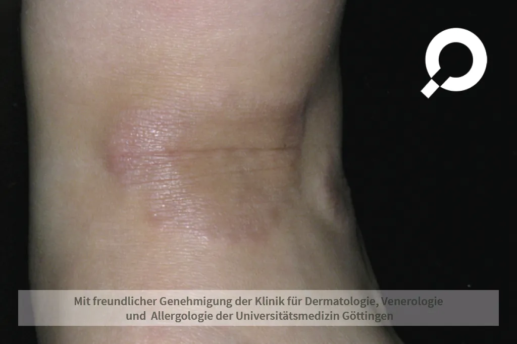 Granuloma anulare