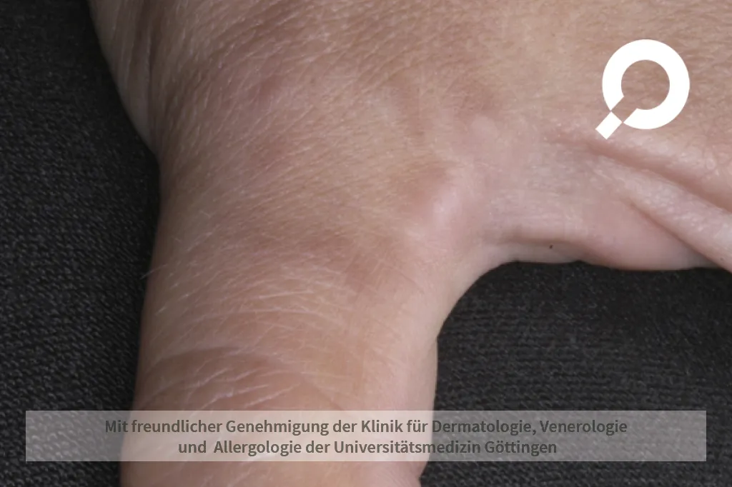 Granuloma anulare