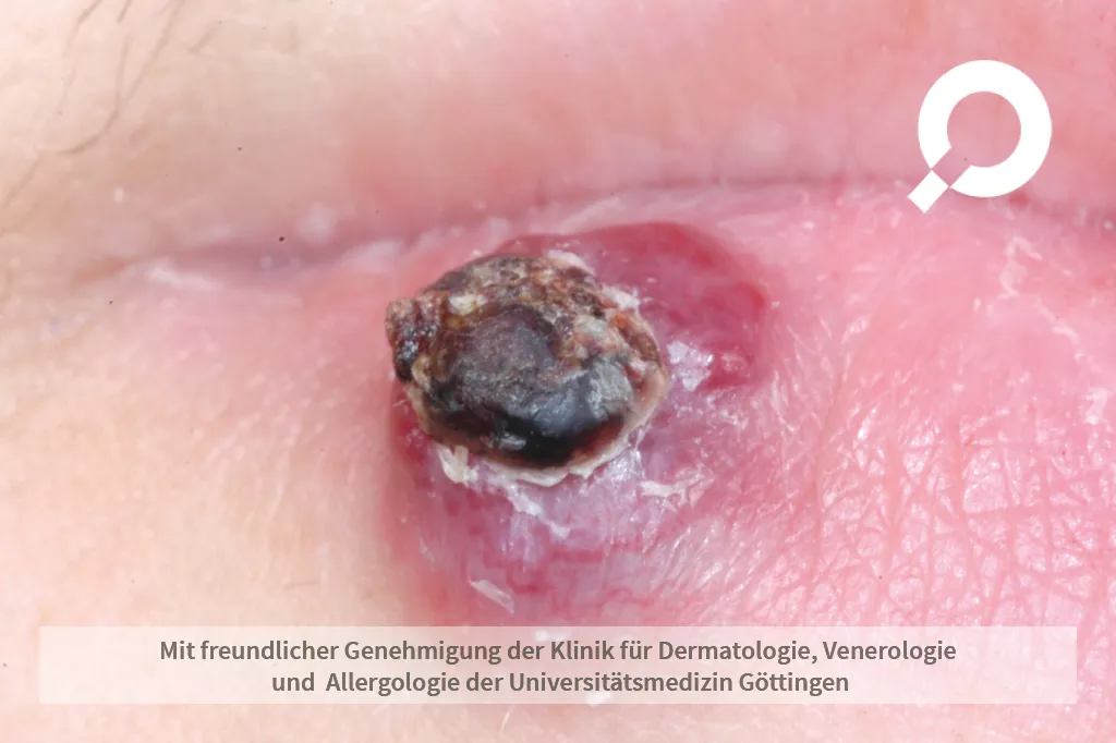 Patient mit einem pyogenes Granulom