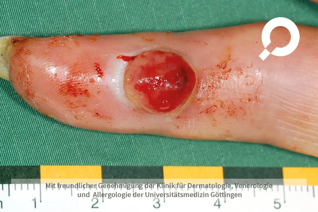 Bild eines Fingers mit einem Granuloma Pyogenicum