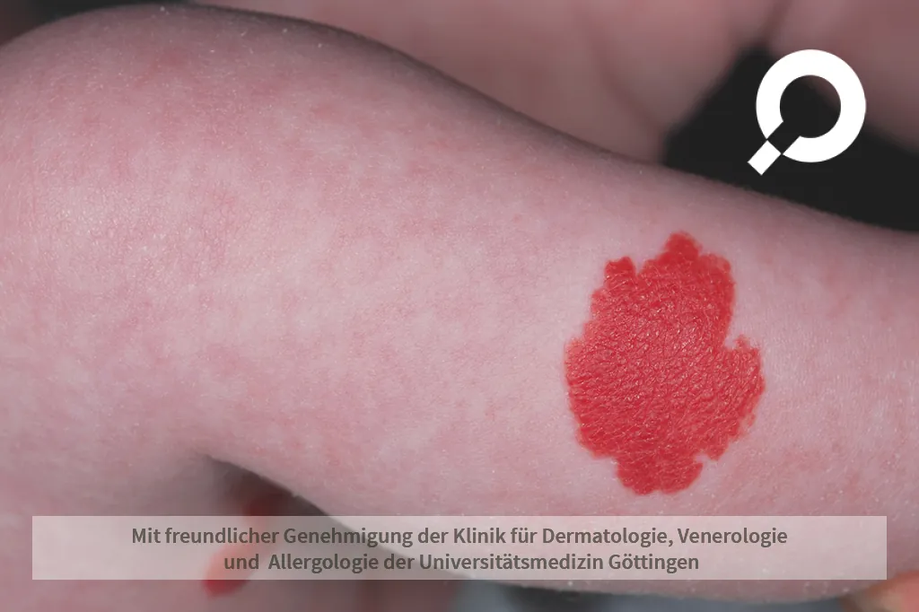 roter Fleck am Oberarm Hämangiom Blutschwämmchen