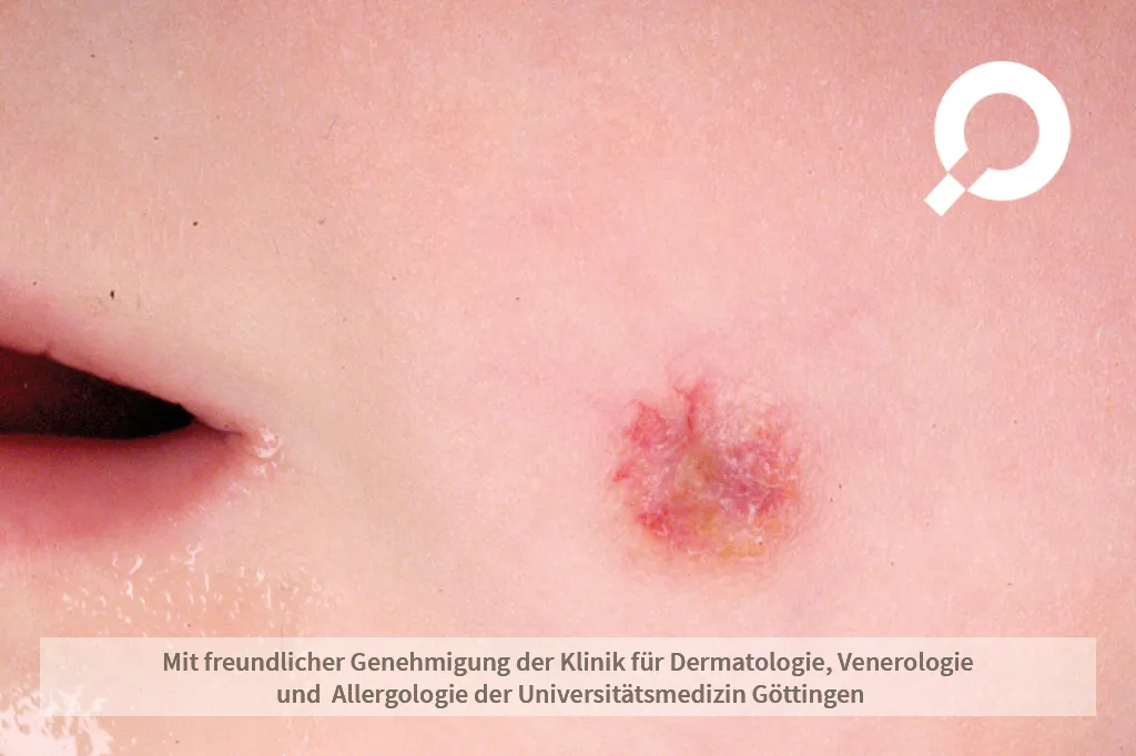 Fleck an der Wange Hämangiom Blutschwämmchen