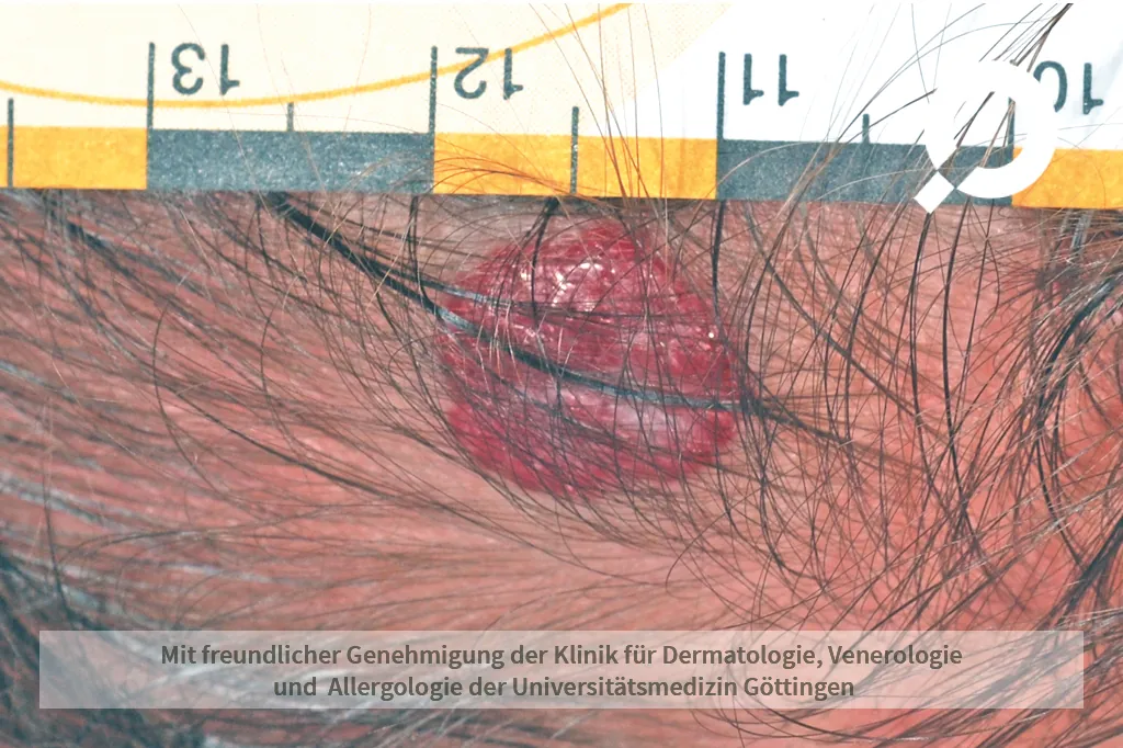 roter Fleck auf dem Kopf Hämangiom Blutschwämmchen