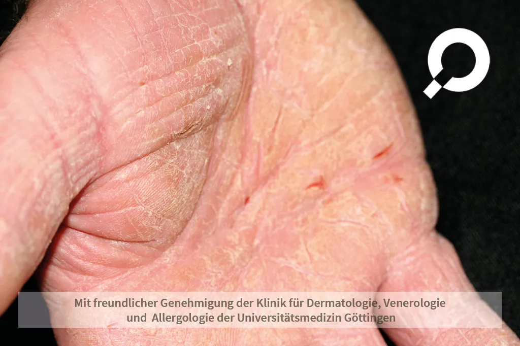 Handekzem gerötete trockene Hände