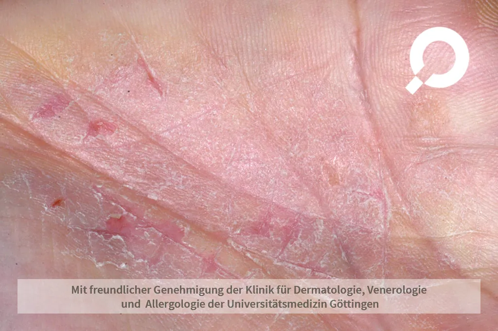 Handekzem gerötete trockene Hände