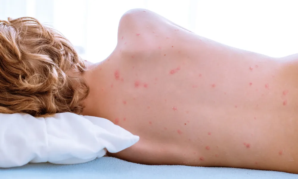 Hautausschlag Kind