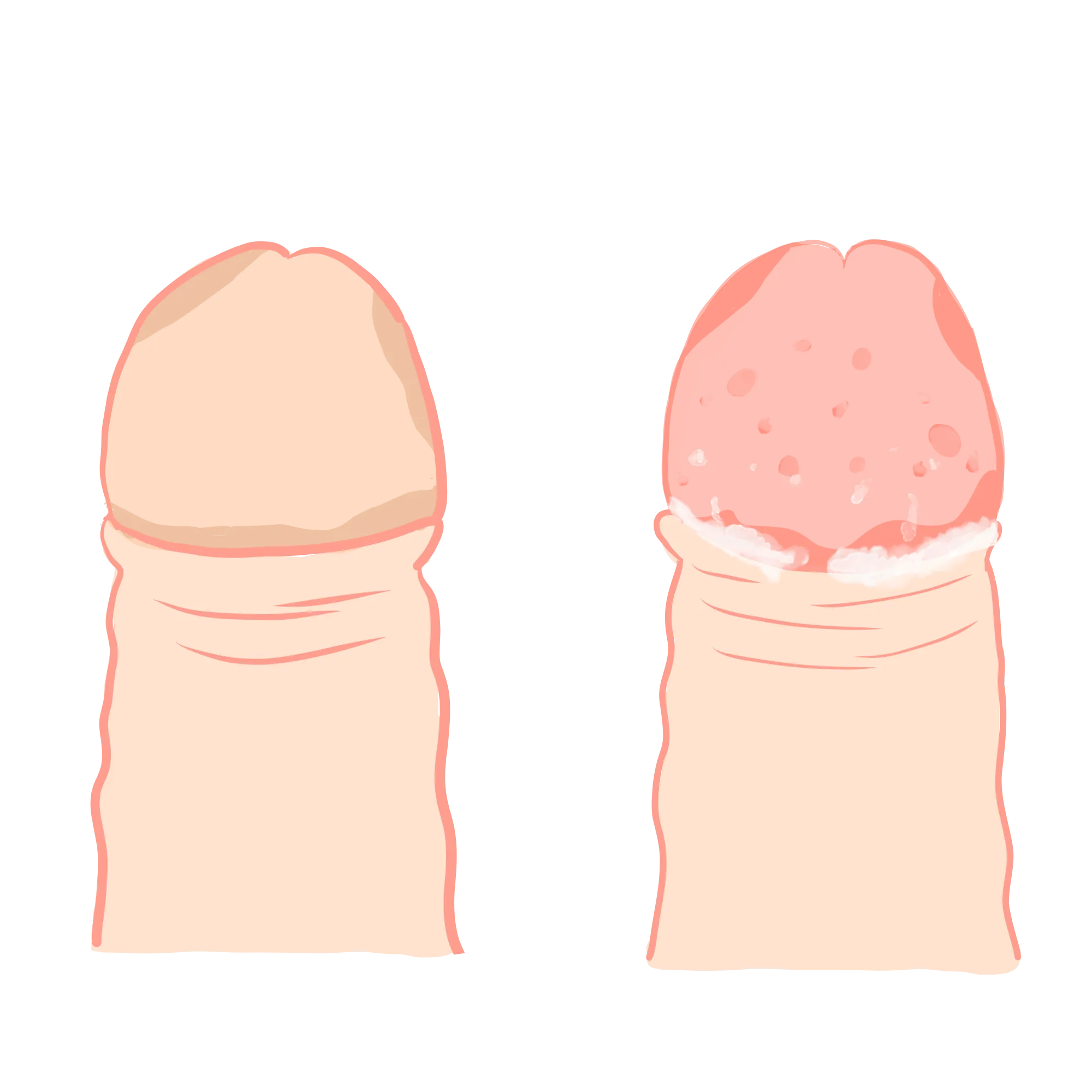 Illustration die eine gesunden mit einer an Balanitis erkrankten Eichel zeigt