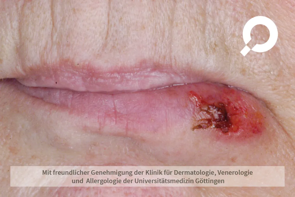 Wunde am Mundwinkel