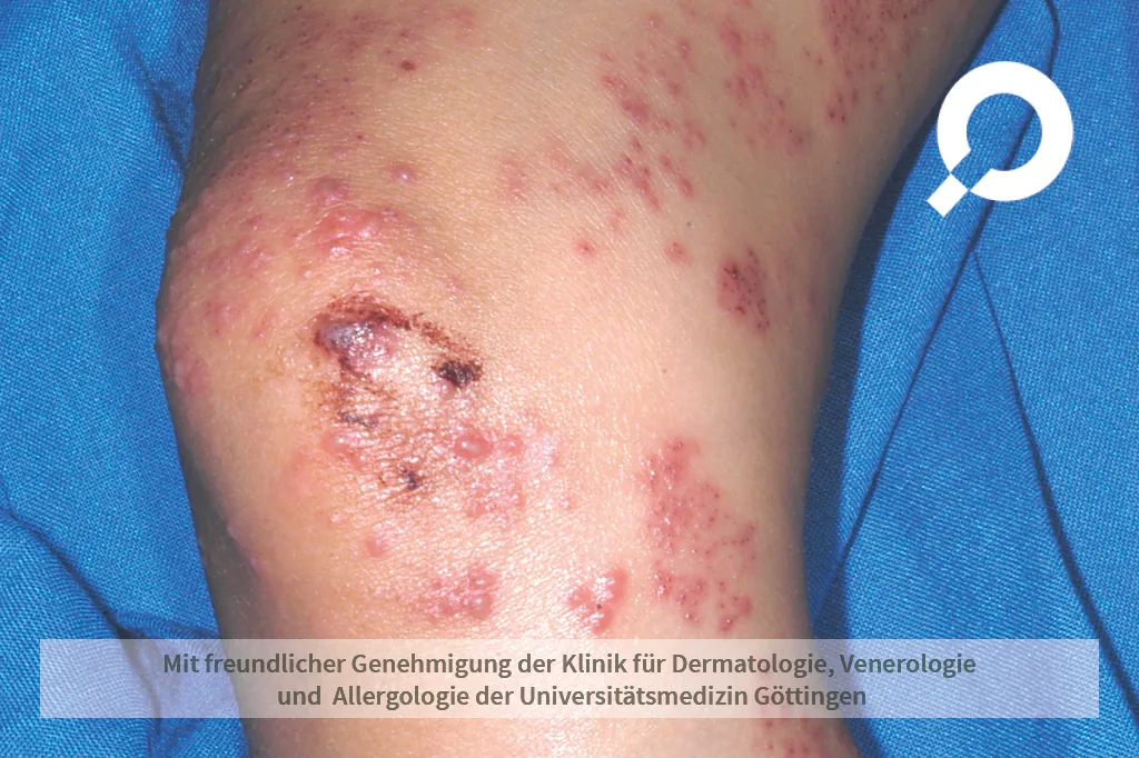 Herpes Zoster (Gürtelrose)