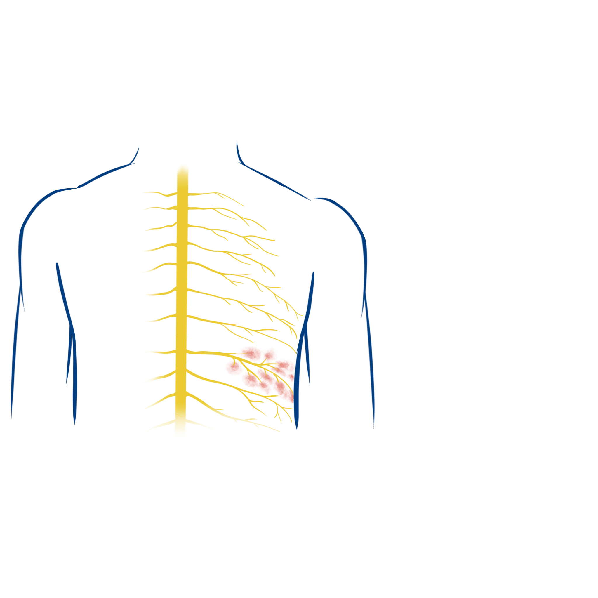 Illustration zur Ursaache von Herpes Zoster