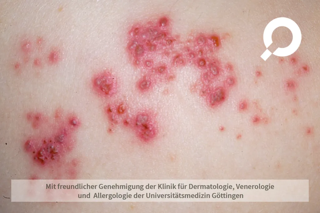 Herpes Zoster (Gürtelrose)