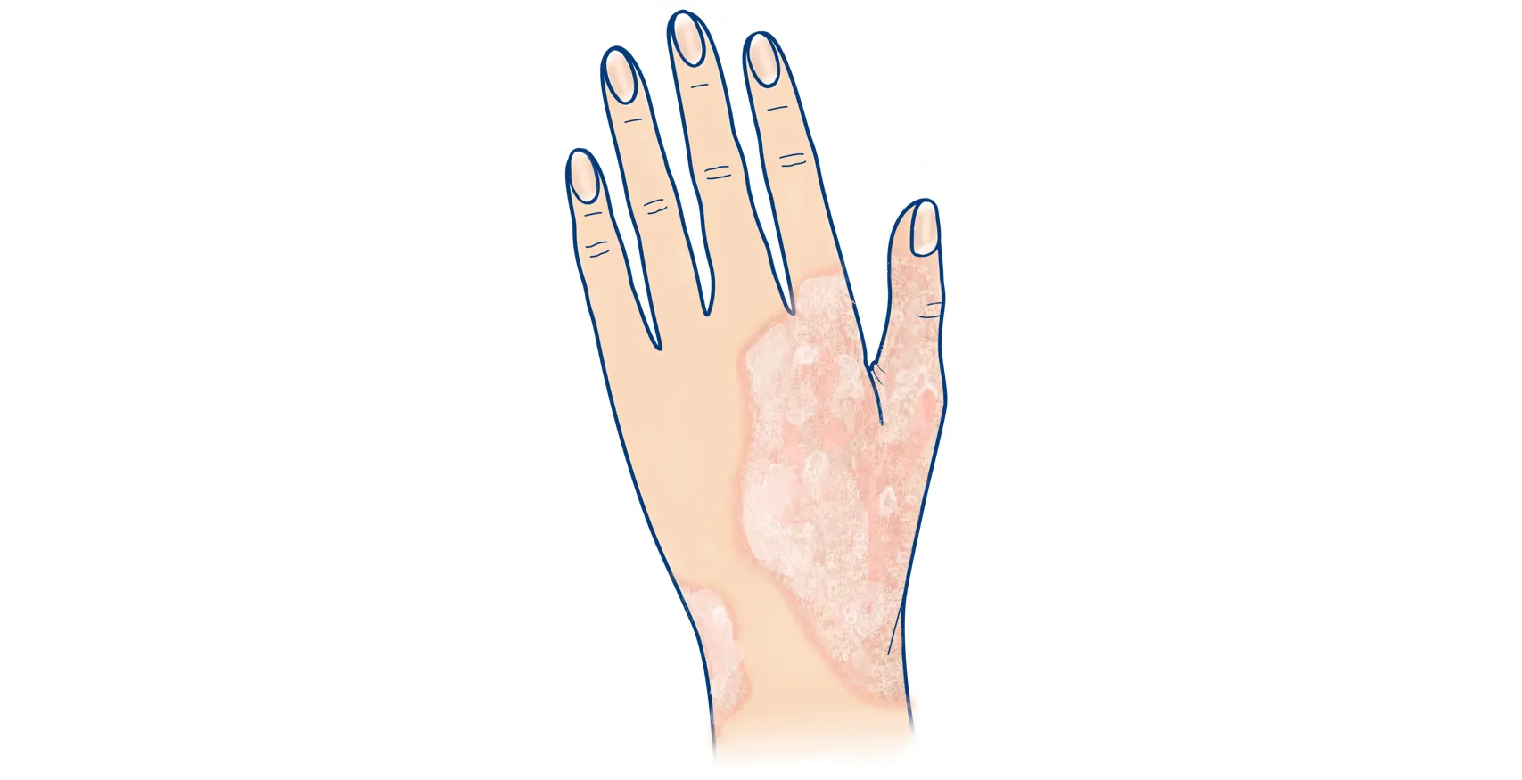 Illustration einer Psoriasis Entzündung an der Hand