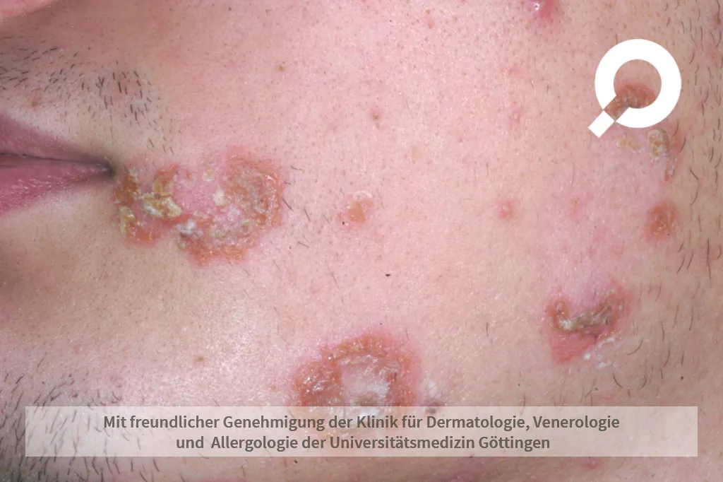 Beispielbild der Symptome bei Impetigo Contagiosa