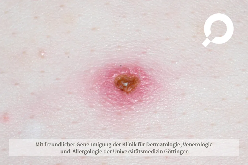 Insektenstich auf der Haut