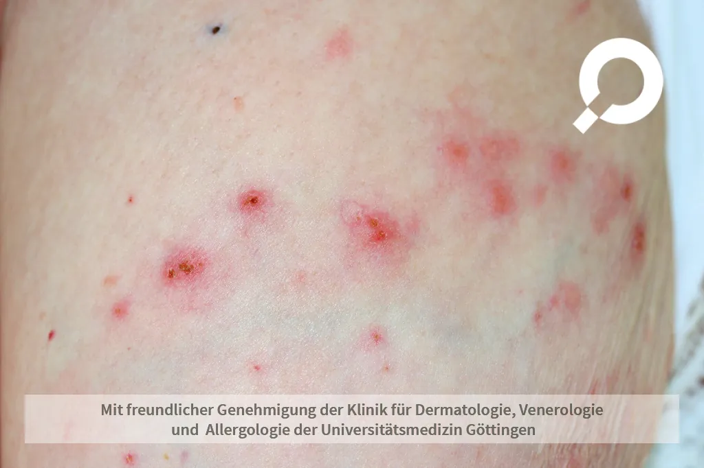 Insektenstiche am Oberarm