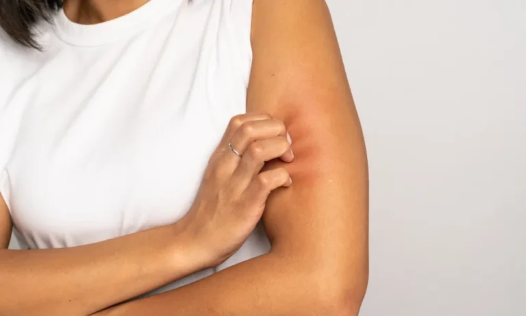 Insektenstich, Juckreiz, Kratzen, Stechfliegen, Mücke, Zecke