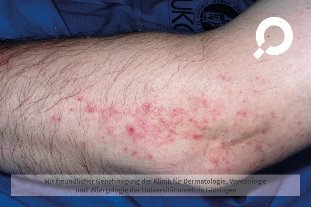 Allergie am Arm