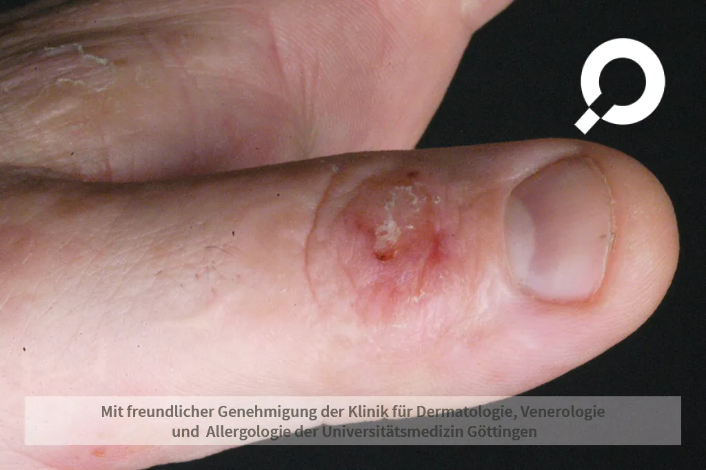 Wunde am Daumen