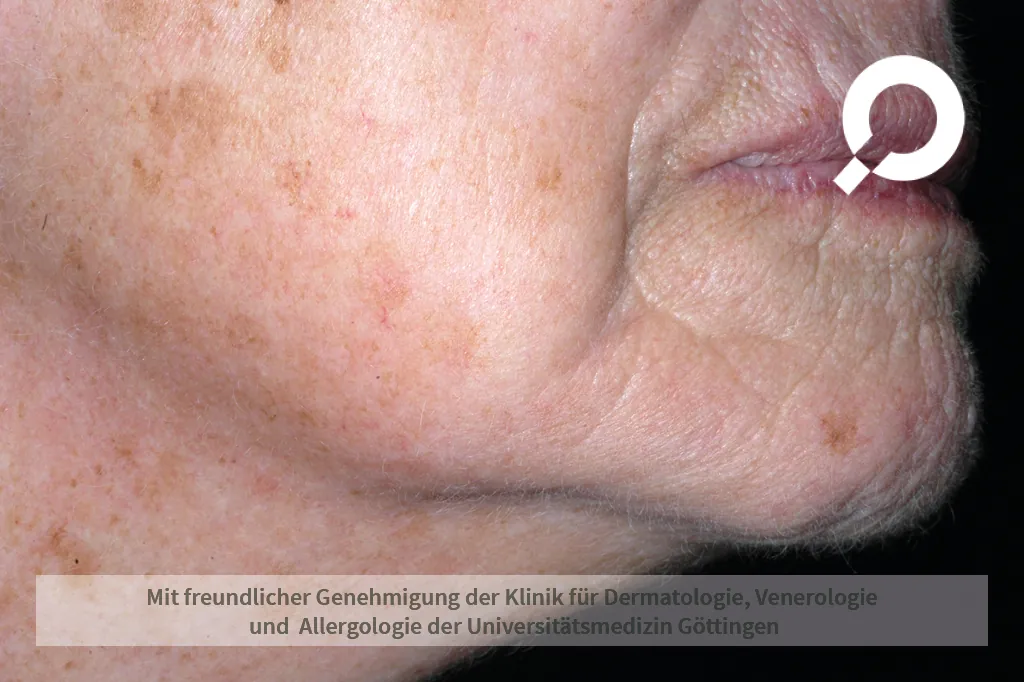 Lentigines Solares (Altersflecken) im Gesicht