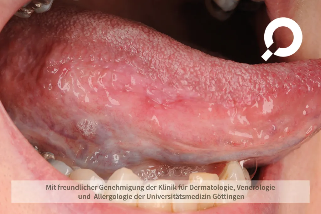 weiße Punkte auf der Zunge