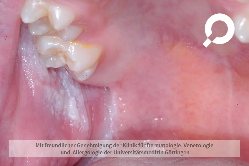 weiße Punkte im Mundinnenraum