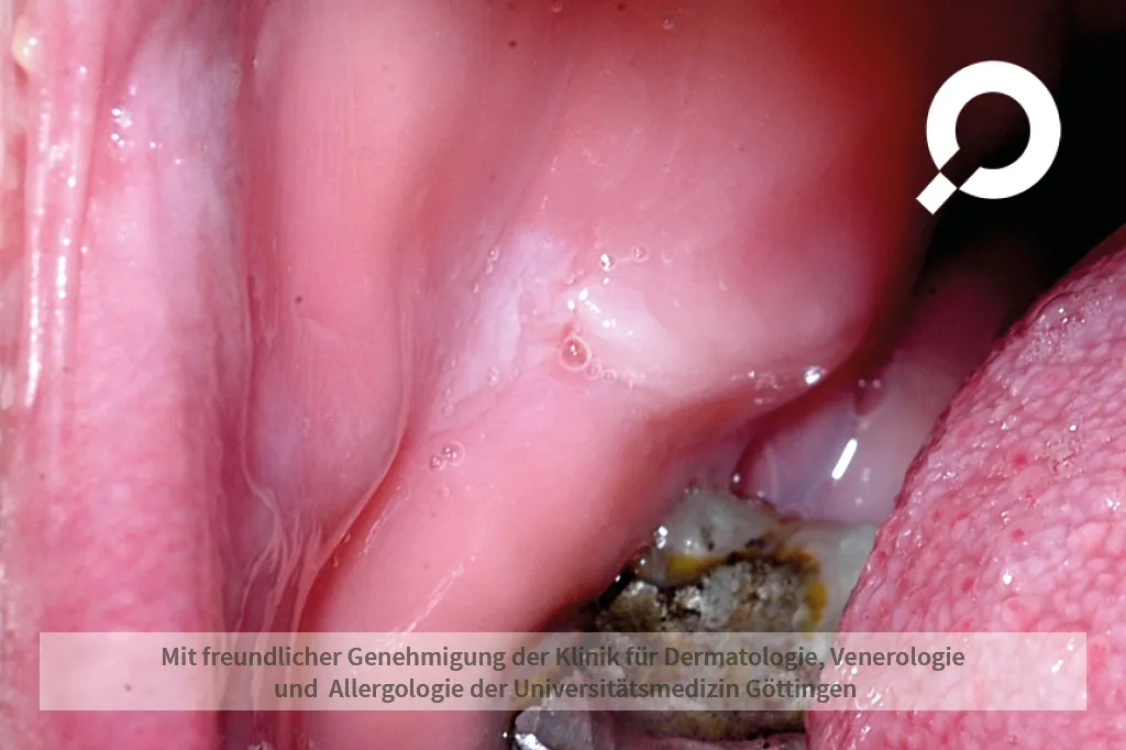 weißer Punkt im Mundinnenraum
