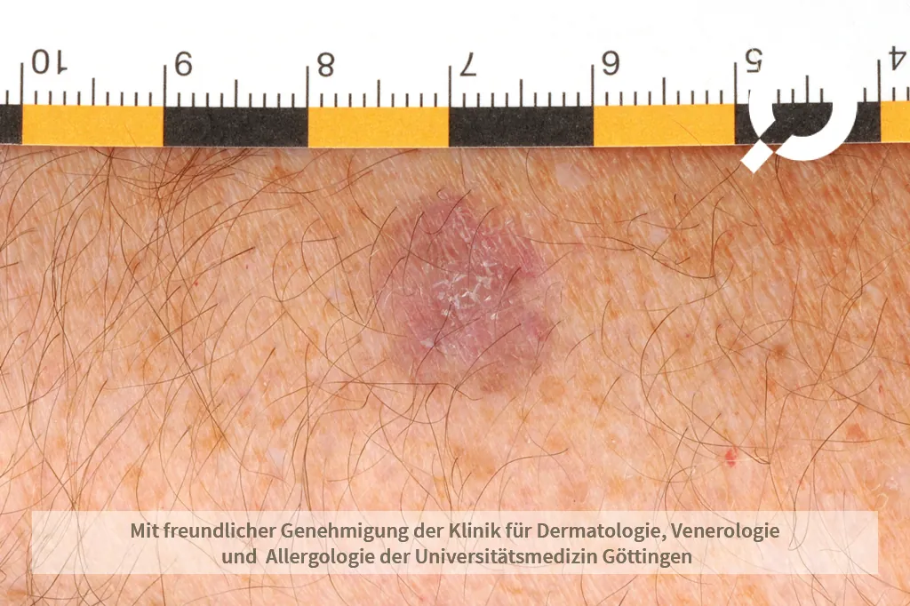 lila Fleck auf der Haut