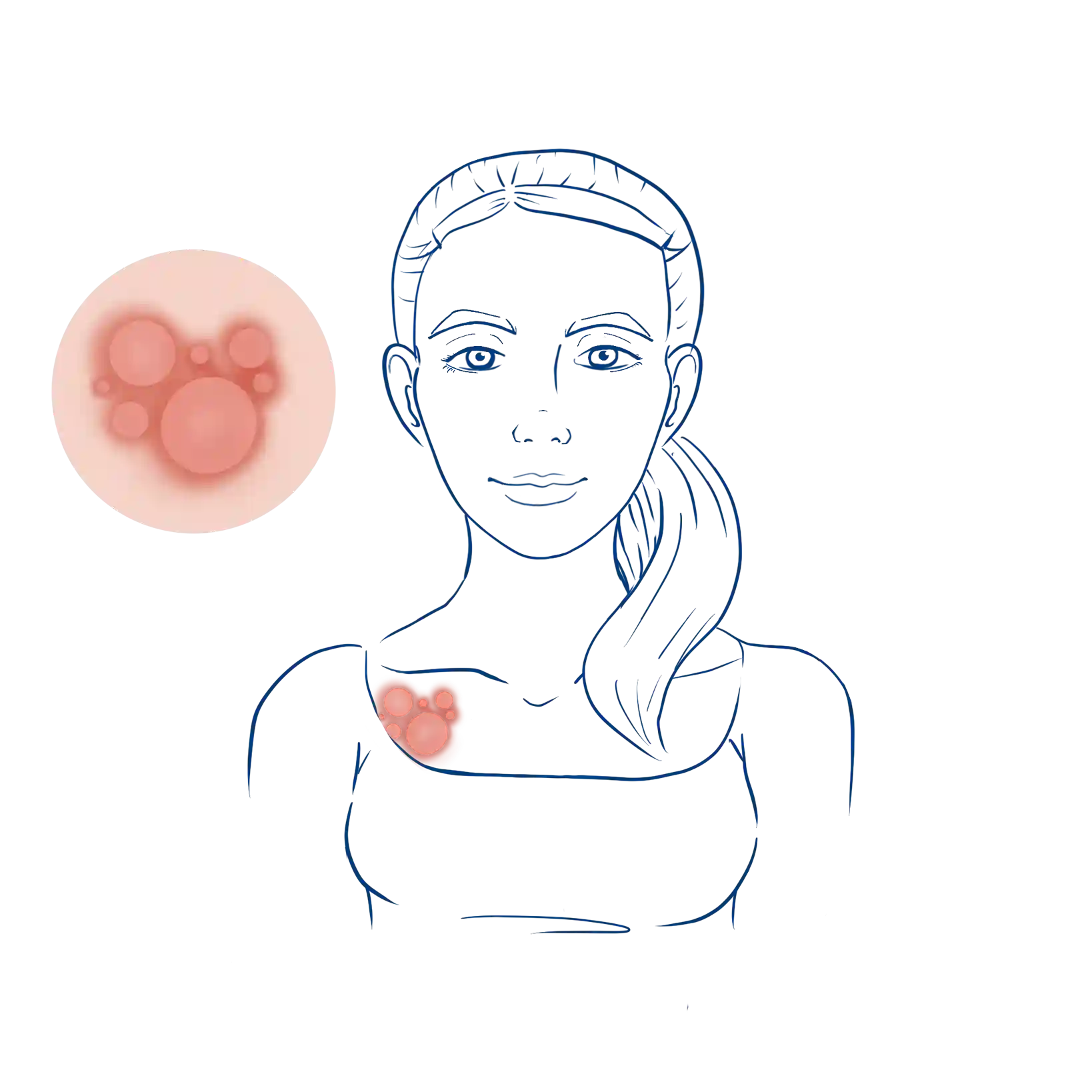 Illustration wie ein Lichen Ruber Planus aussehen kann