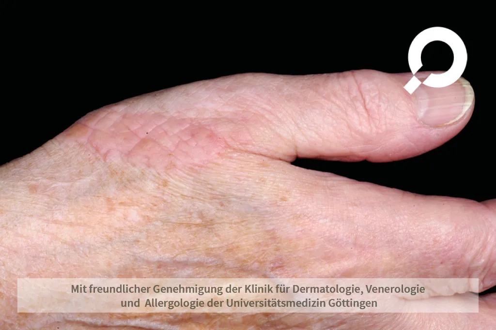 Knötchen an der Hand