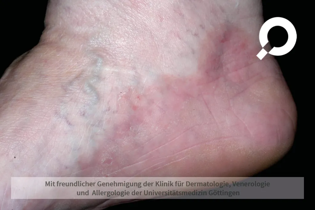 Beispielbild Symptome Lichen ruber