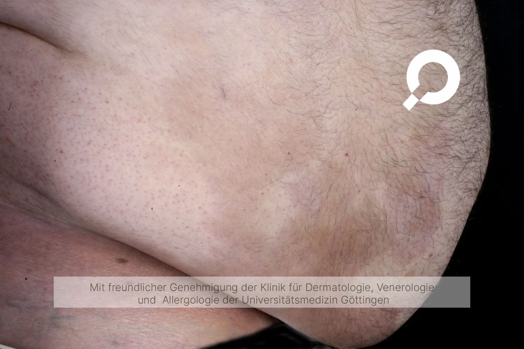 Vernarbung braune Flecken Bauch