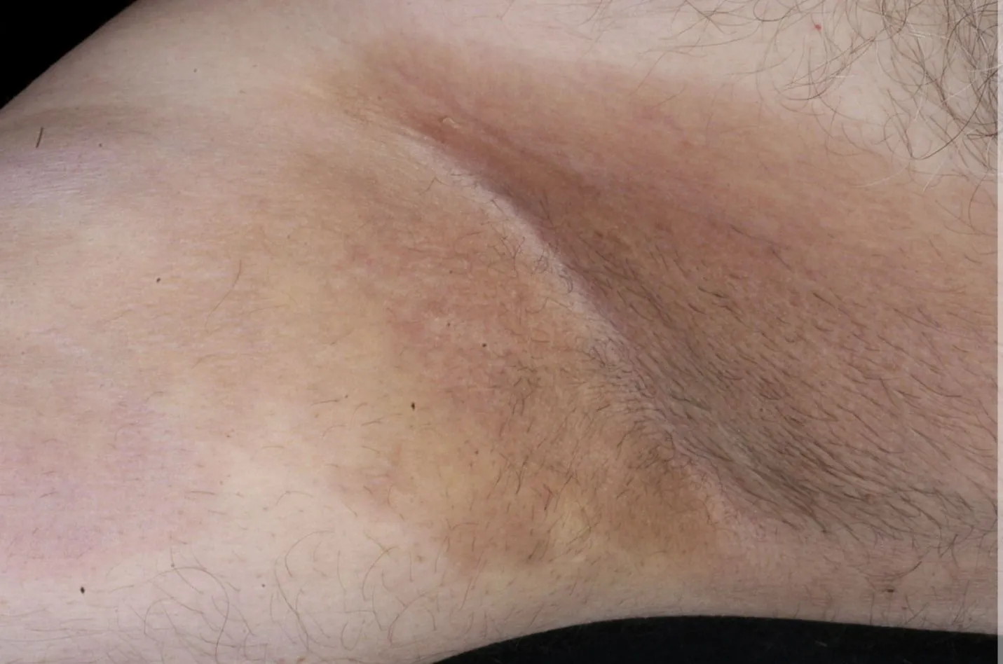 braune Verfärbung Achsel