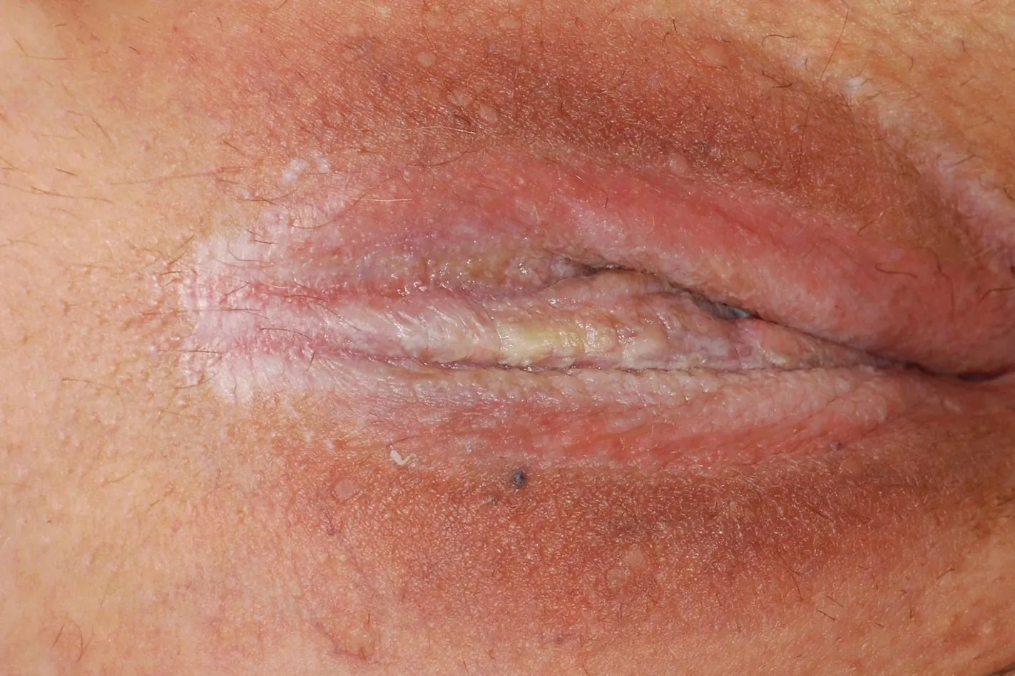 Vernarbung weiße flecken Scheide