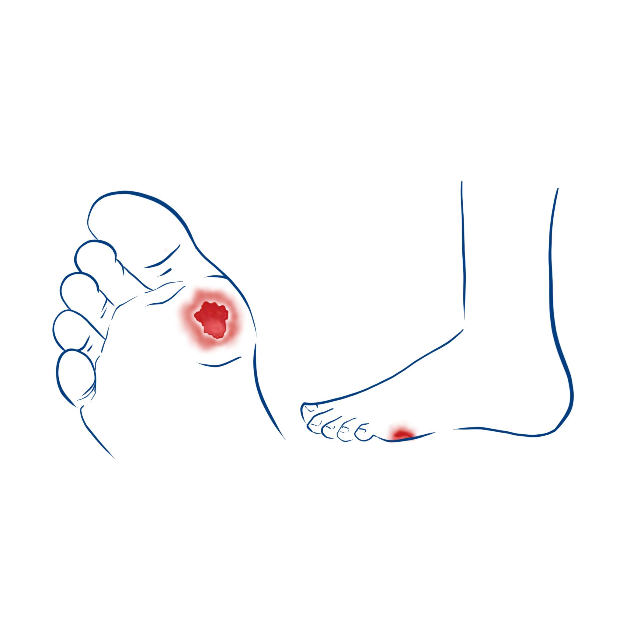 Illustration zum Symptome bei Malum Perforans Erkrankung