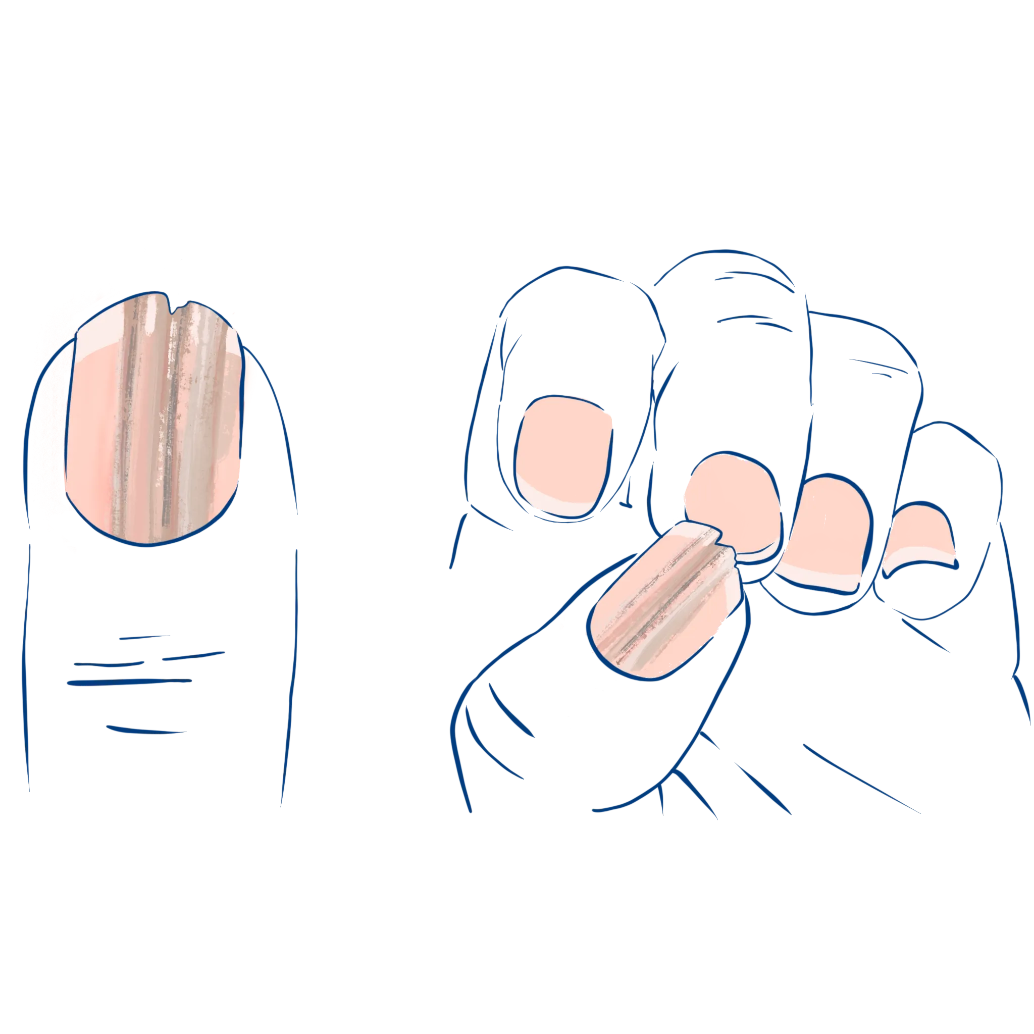 Illustration der Symptome bei Melanochia Striate